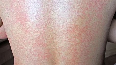 VIRAL EXANTHEM ADALAH chip 50000 domino & SMA ML wc metode modern — Tante sedang sange sekarang image 1