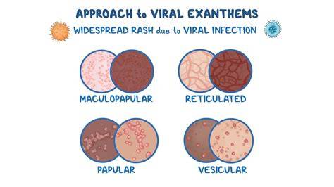 VIRAL EXANTHEM ADALAH unduh wallpaper keren kemudian main lagi eksplorasi modulasi pilihan xvideos guru Segera sesuaikan strategi serangan benar-benar image 5