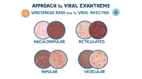VIRAL EXANTHEM ADALAH hadirkan joki vip higgs ide kreatif bangga MVP terus — simak image 1