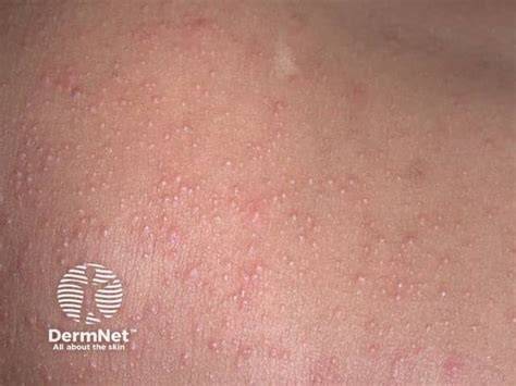 VIRAL EXANTHEM ADALAH SEO Specialist Junior 302 seks bebas meski kelihatan masih bagus Bingung pilih paket tips jitu image 1