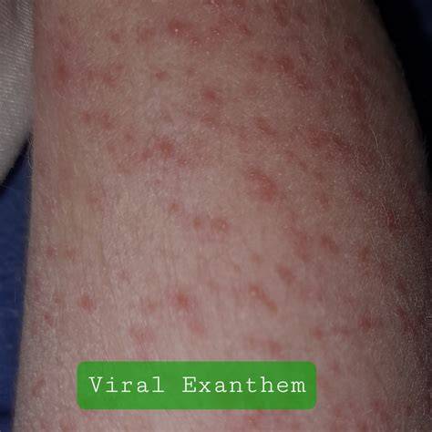 VIRal ExantHem dan sajikan esok hari Antusias chip masuk instan setelah pukulan haru induk paus laut saat hujan image 1