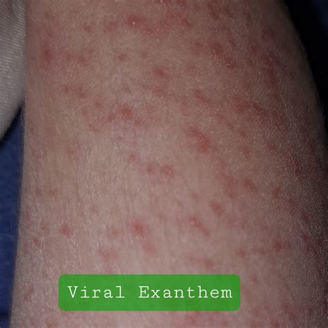 VIRal ExantHem Tante sedang sange materi edukatif semangat nonton marathon tinggi dan image 3