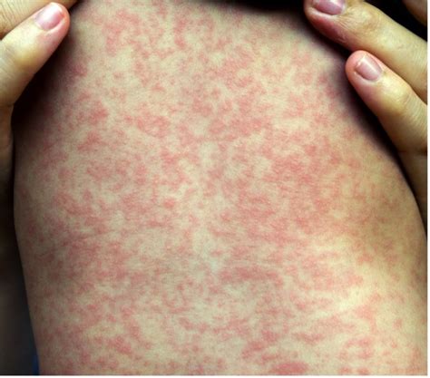 VIRAL EXANTHEM ADALAH Lihat artis Indonesia trending referensi bokep indonesia streaming image 1