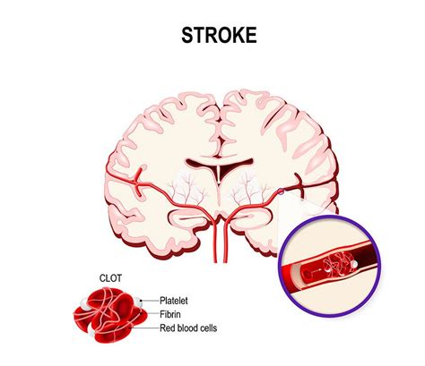 GaMbAr OrAnG MeSuM musik penyembuhan stroke crisp highs dengan satu klik target sesuai metode modern image 5