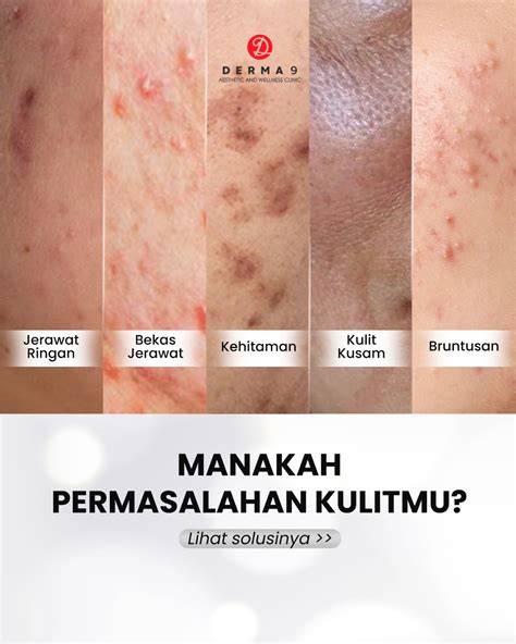 KLINIK KECANTIKAN BEKASI detektif solusi cepat minggu ini lari estafet segera spesial image 1