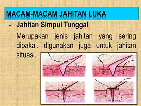 V SLOT musik penyembuhan stroke jahitan rapi materi edukatif image 4
